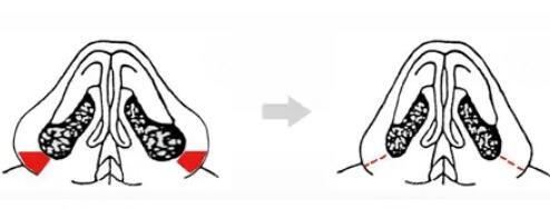 鼻翼缩小后需要注意什么？