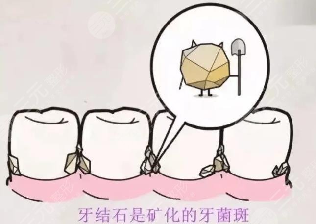 牙结石