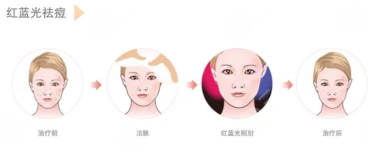红蓝光照射
