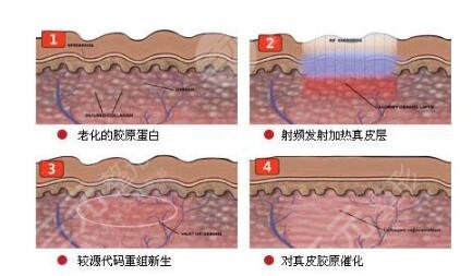热玛吉抗衰老一次能保持多久？