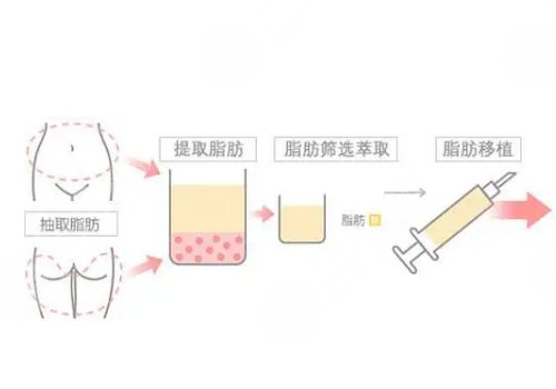 面部自体脂肪填充可以维持多久？