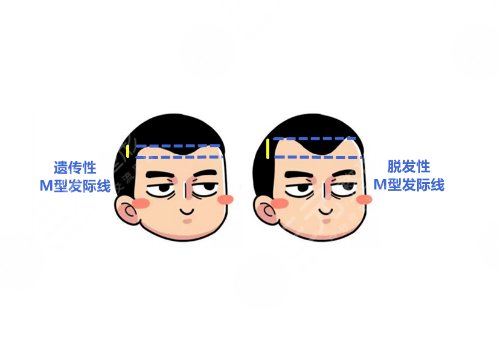 发际线高怎么挽救?