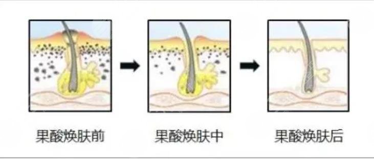 去黑头
