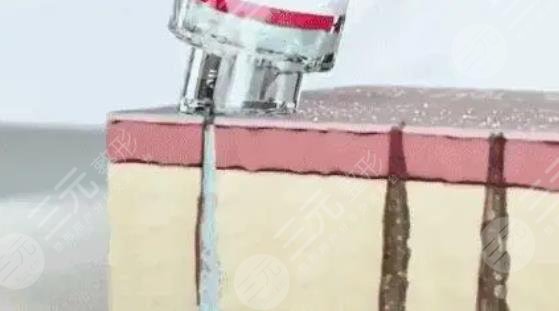 去黑头