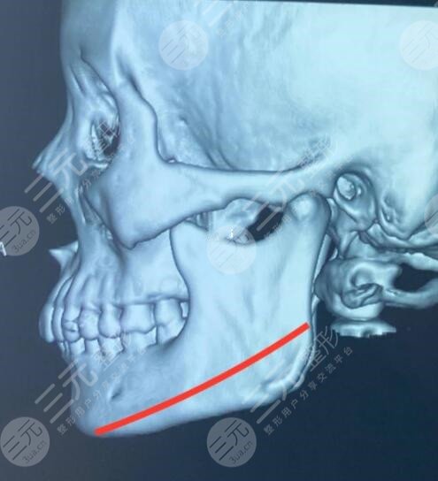 磨骨手术全过程3D果展示！磨骨手术果可以维持多久？手术注意事项有哪些？