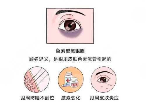 去黑眼圈后的护理