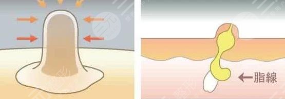 眼睛周围长脂肪粒怎么办?