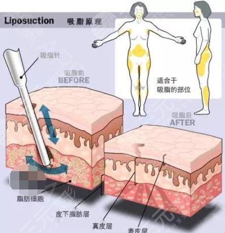 光纤溶脂