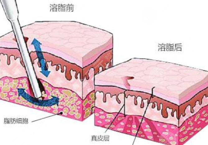 光纤溶脂