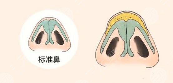 鼻尖整形