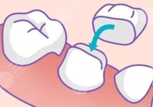 烤瓷牙套多少钱一个?