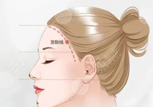 发际线移植能保持多久？