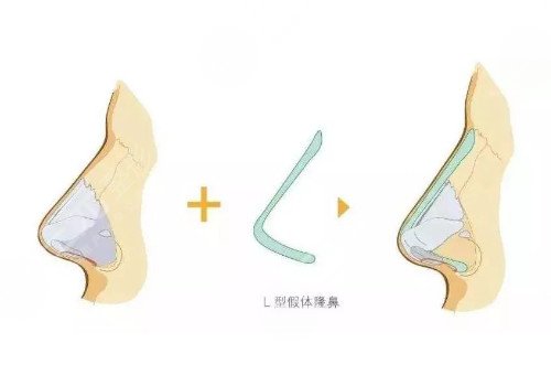 假体隆鼻注意事项
