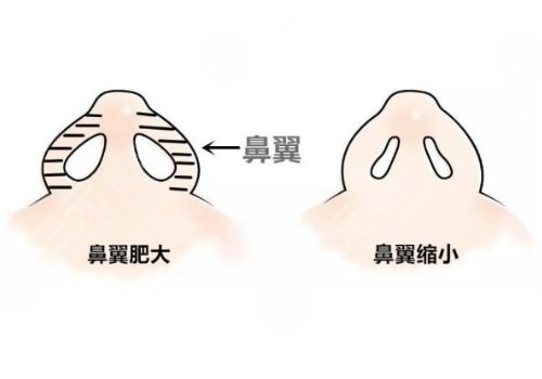 鼻头缩小手术的费用大概是多少?