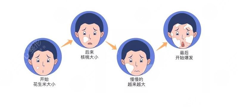 白点癜风治疗费用多少?