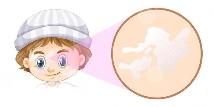 白点癜风治疗费用多少?