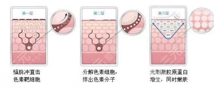激光美白