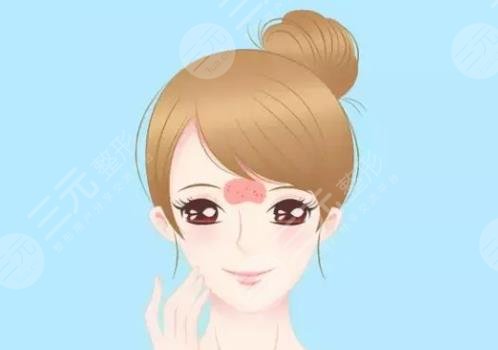 额头长痘