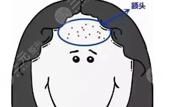 额头长痘