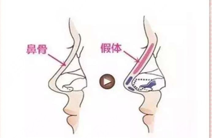 膨体隆鼻