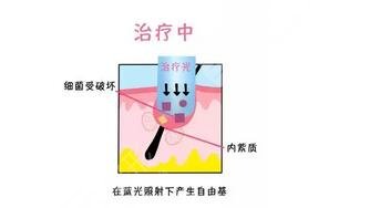 红光治疗痤疮多久一次?