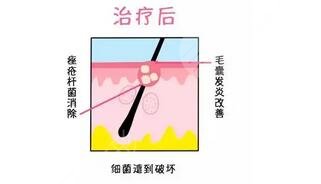 红光治疗痤疮多久一次?