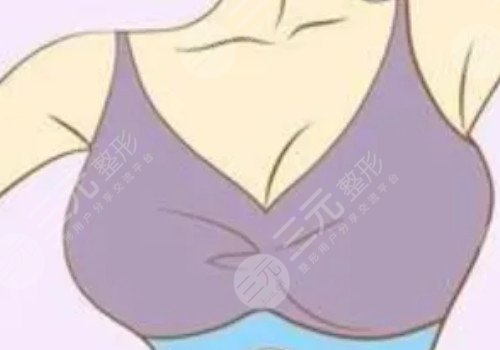 什么是假体隆胸手术?