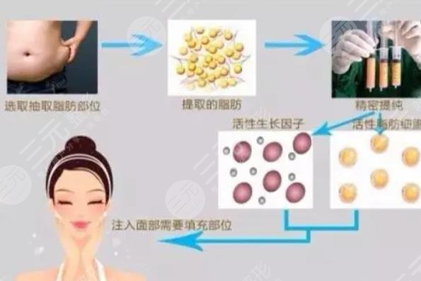 下巴填充
