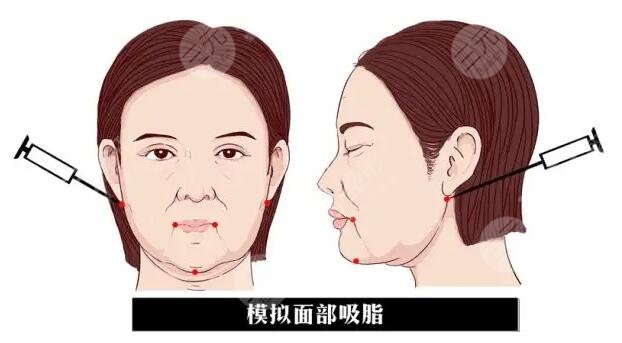 面部吸脂果好吗怎么样?