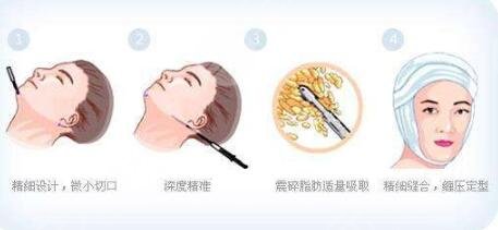 面部吸脂手术风险