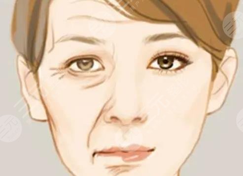 鱼尾纹