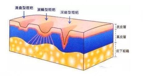 做完光子嫩肤祛痘之后需要注意什么?
