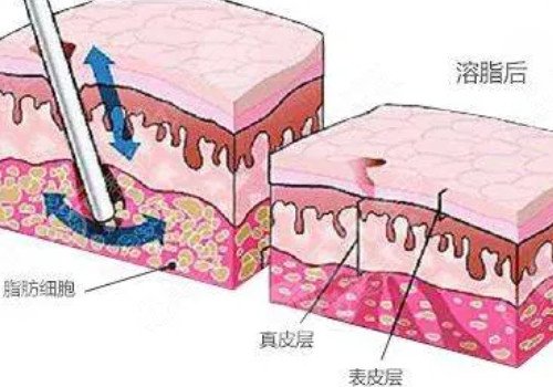 镭射溶脂