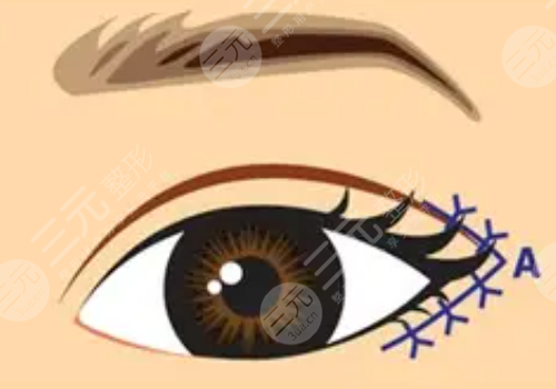 开眼角疼不疼?和不开的区别是什么?