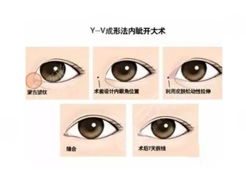 开眼角疼不疼?