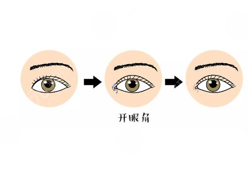 开眼角疼不疼?