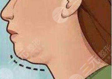 双下巴吸脂