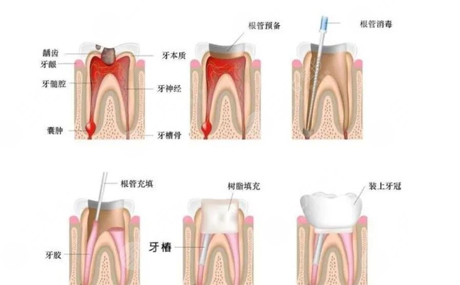 牙龈肿痛有脓包怎么办?