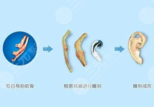 小耳再造多久和正常耳朵一样？