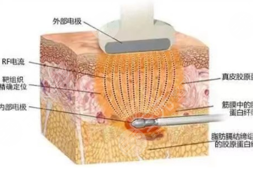 激光祛皱纹果怎么样?