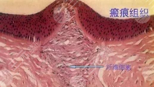 疤痕