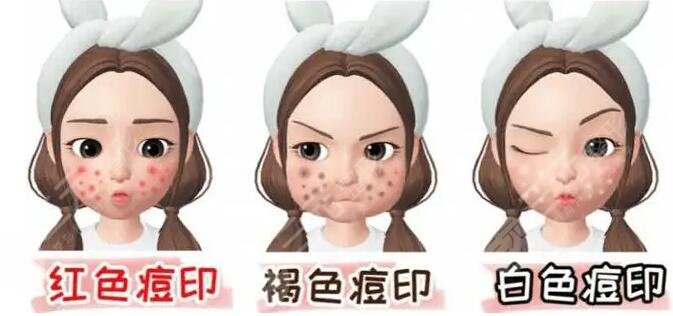 激光去痘印