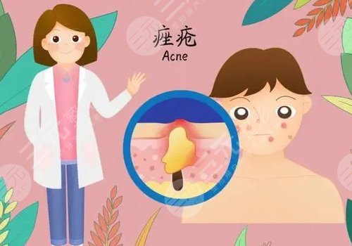 脸上有痤疮怎么办?