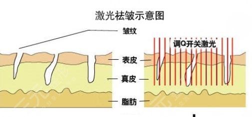 像束激光除皱