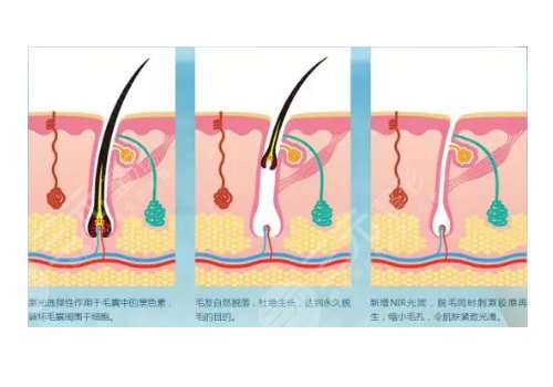 男士激光脱毛果如何?