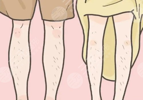 男士激光脱毛果如何?