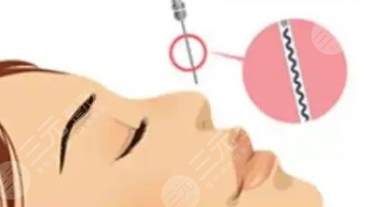 注射胶原蛋白的作用是什么