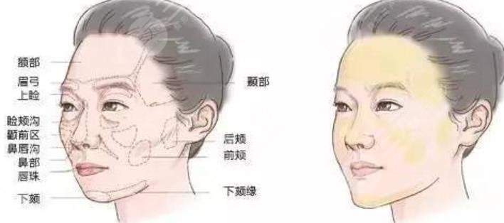 脸部除皱