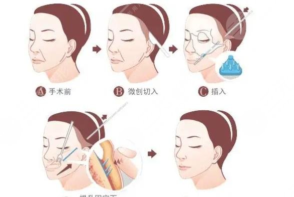 拉皮
