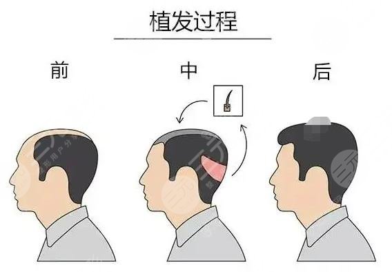 治疗脱发小妙招(民间偏方)